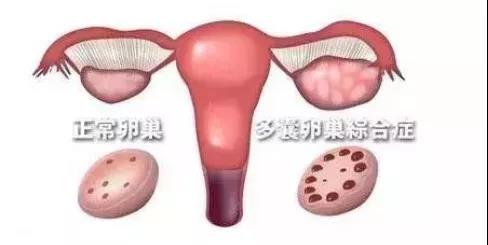 【微课笔记】助孕专家邢卫杰助你应对多囊卵巢迎好孕