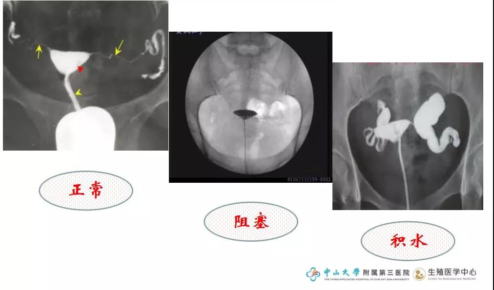 【微课笔记】莫让输卵管问题成了精卵相遇的拦路虎